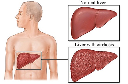 normal liver and liver with cirrhosis